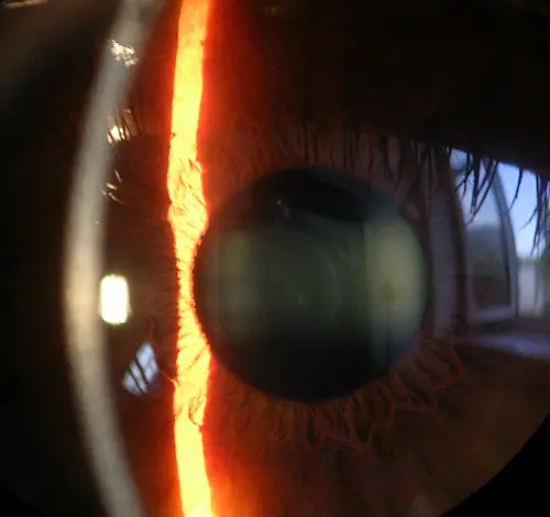 Real slit-lamp photograph showing the cornea in front of the iris and lens.