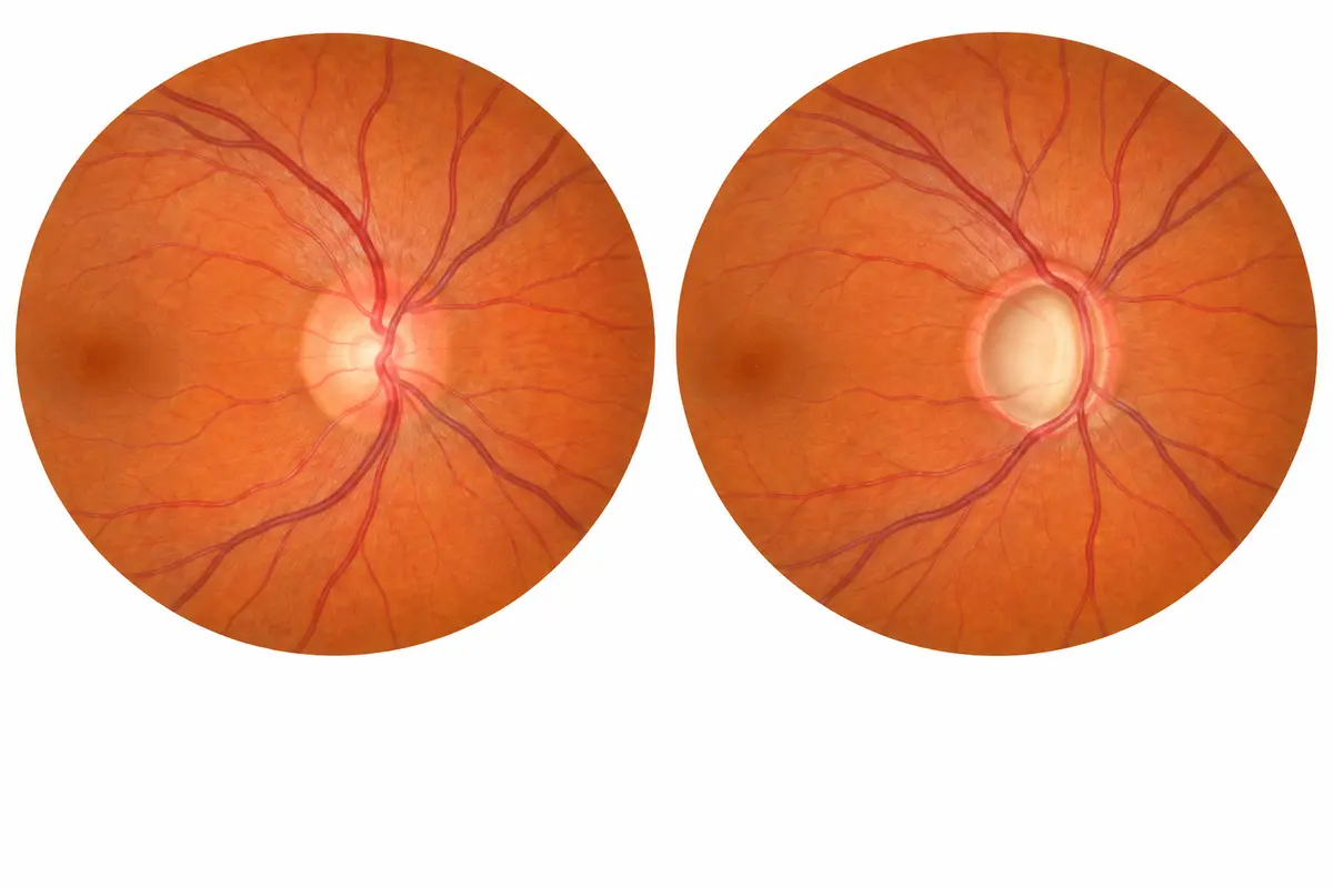 Illustrated optic discs: a smaller central cup on the left and an enlarged cup with a thinner surrounding rim on the right.