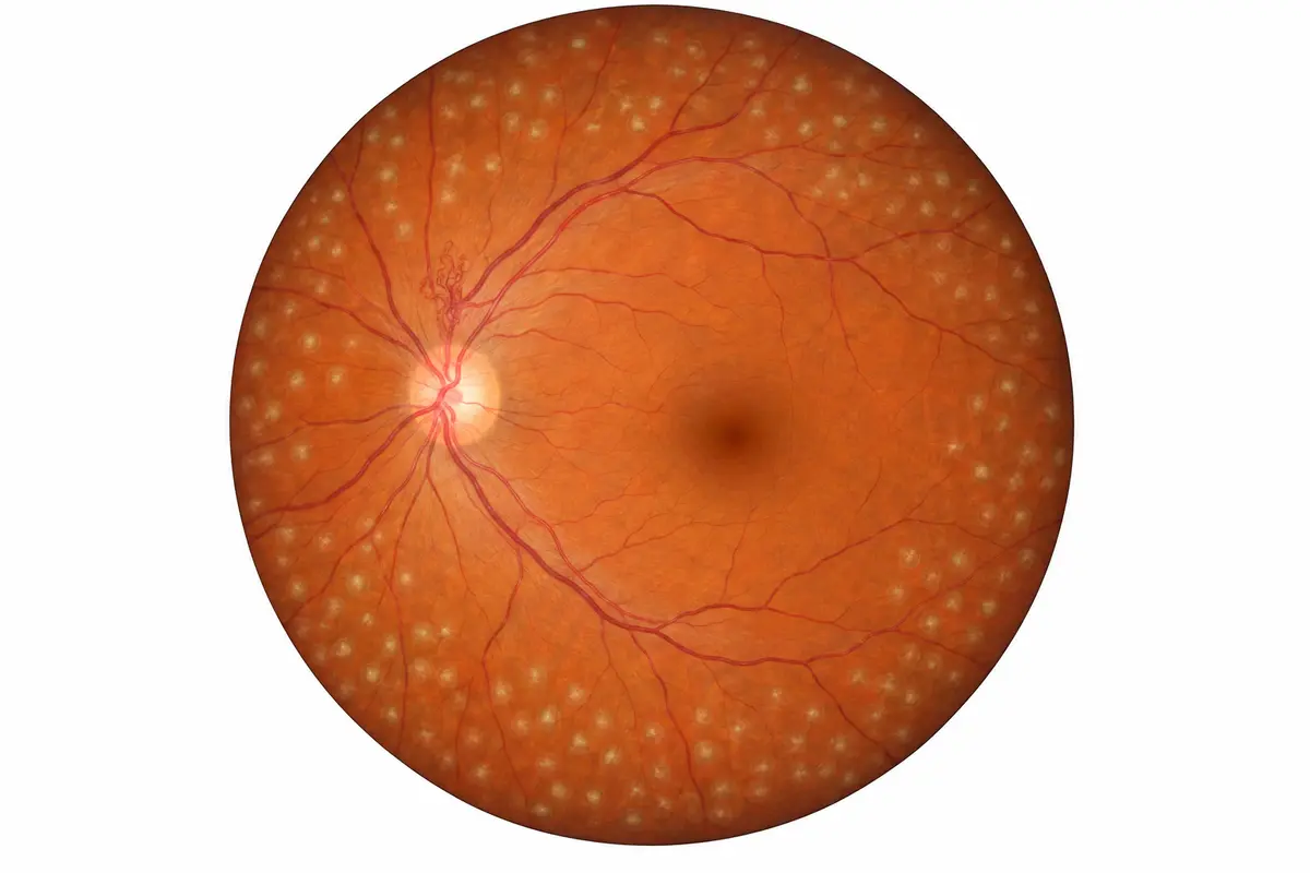Small treatment spots are placed away from the central macula. This illustration explains the pattern; it is not a treatment map.
