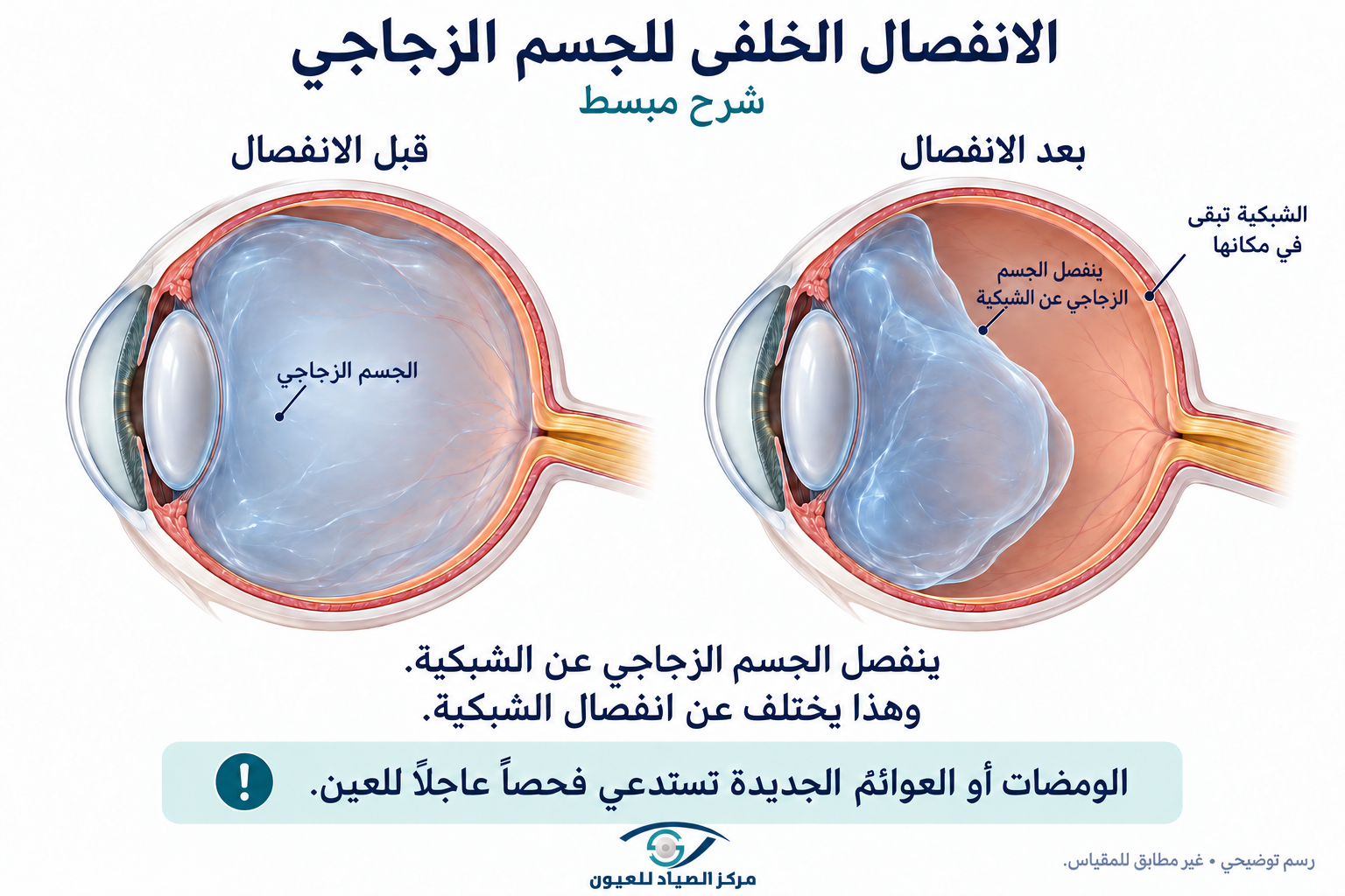 شرح انفصال الجسم الزجاجي الخلفي