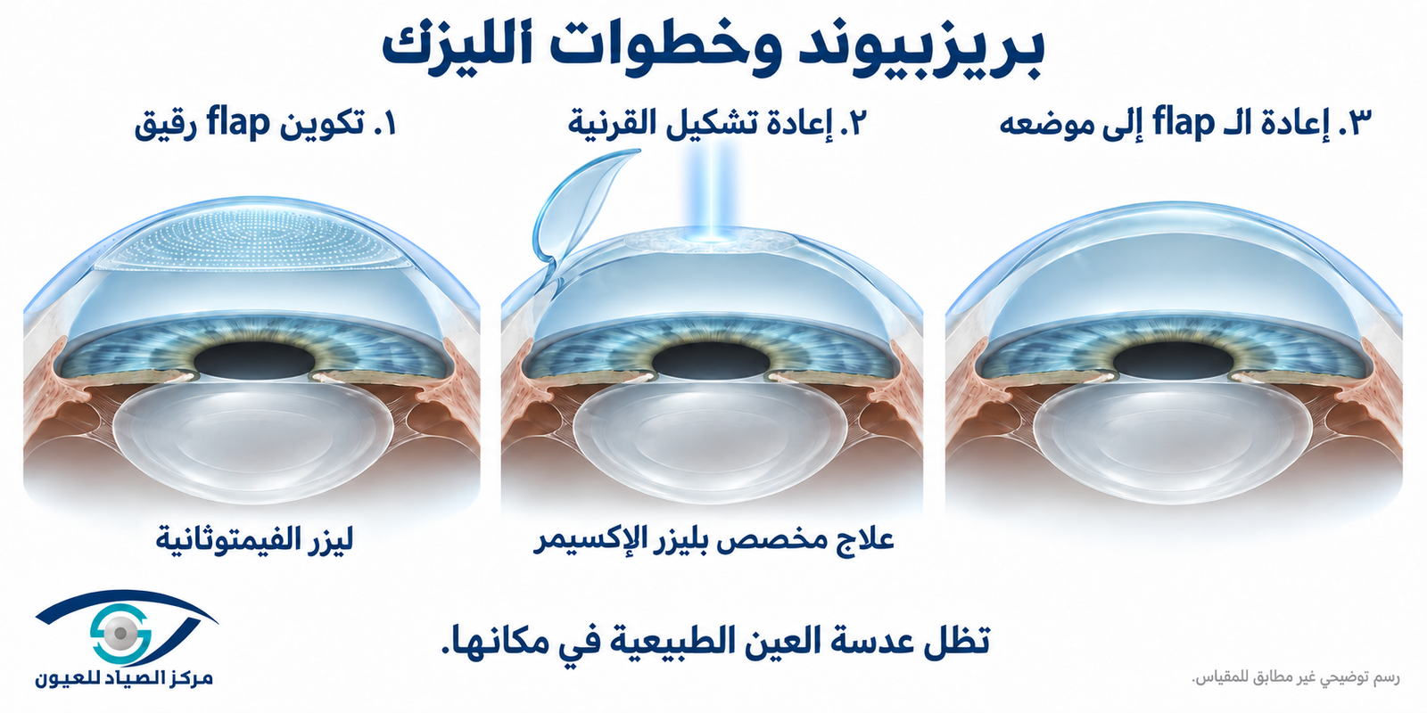 خطوات إجراء بريزبيوند
