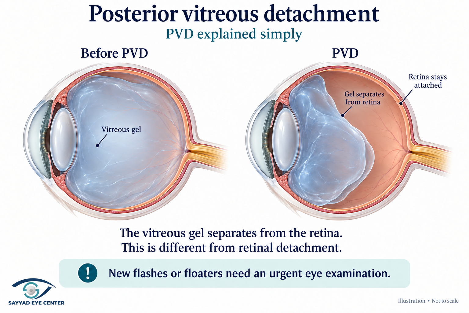 Pvd explained