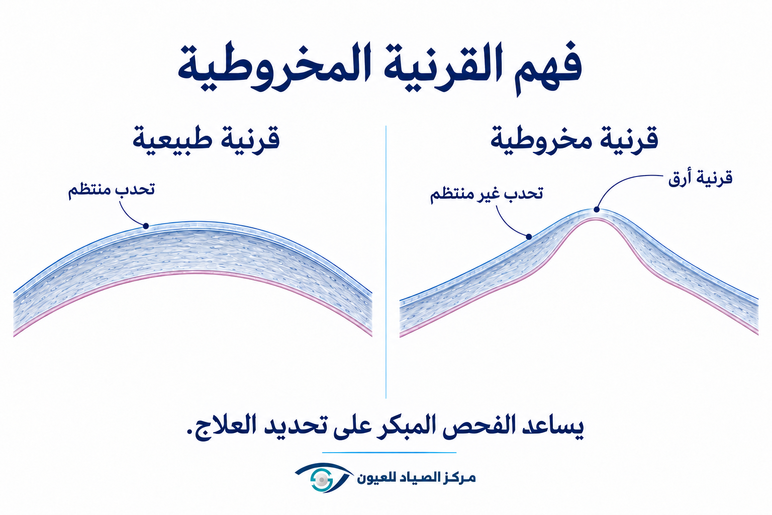 مقارنة القرنية الطبيعية والقرنية المخروطية