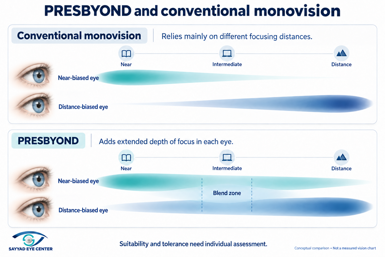 Monovision comparison