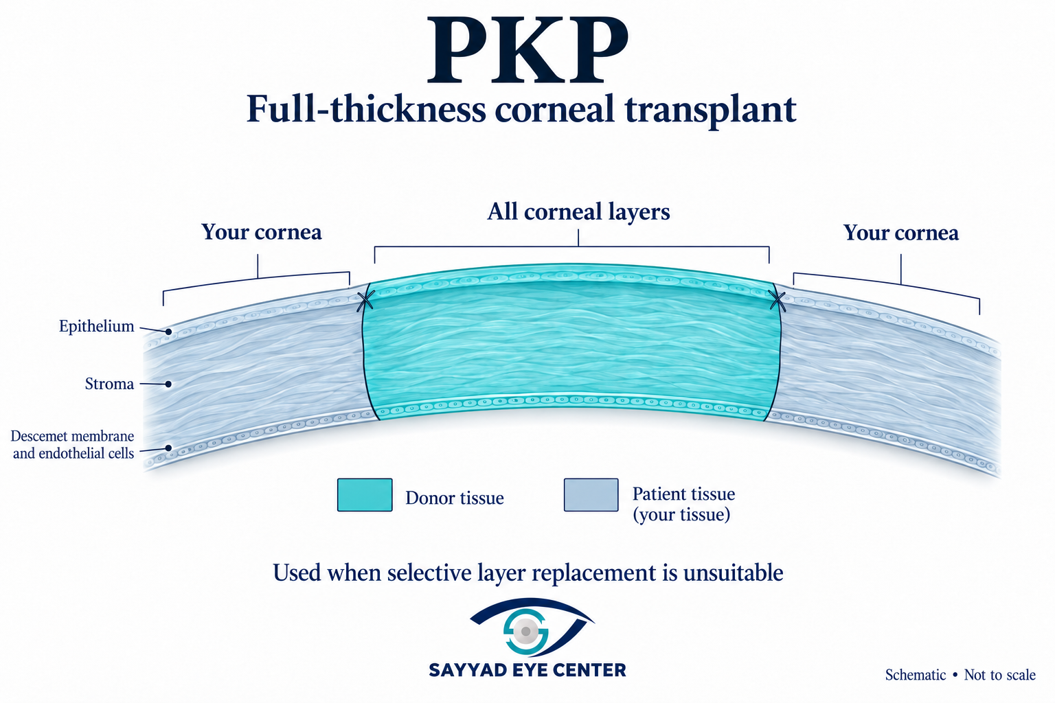 Pkp full thickness corneal transplant
