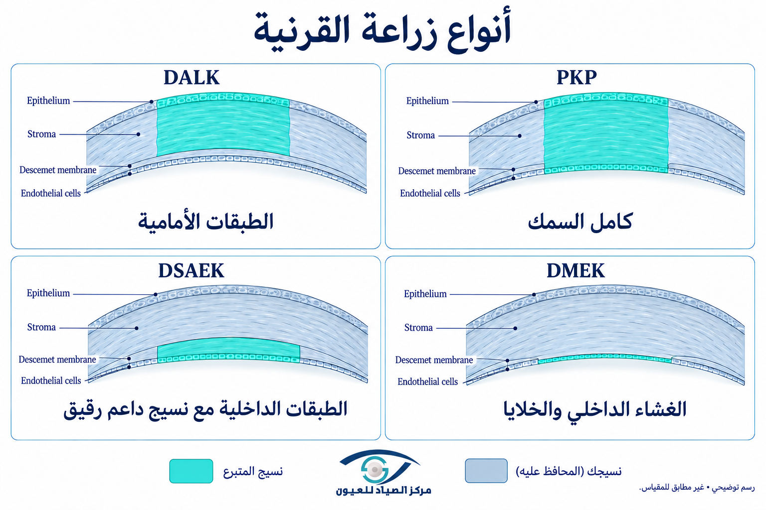 أنواع زراعة القرنية DALK وPKP وDSAEK وDMEK