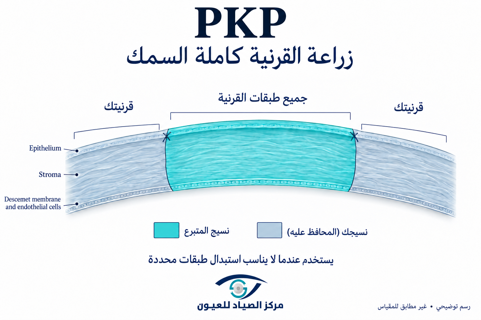 زراعة القرنية كاملة السمك PKP
