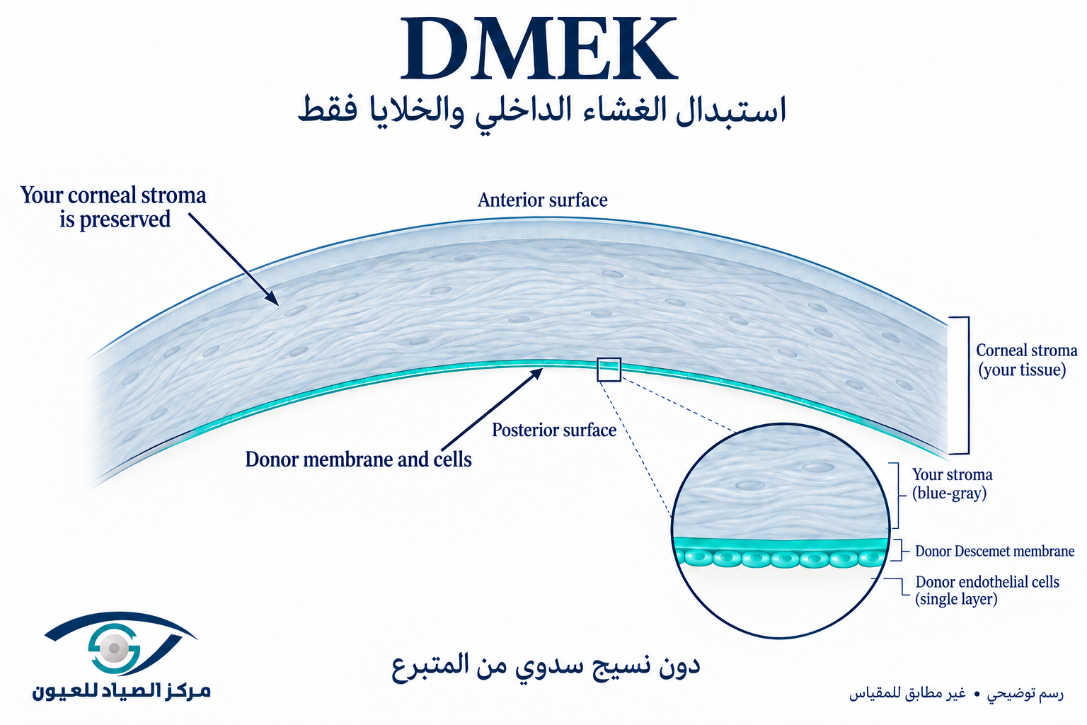 زراعة بطانة القرنية DMEK