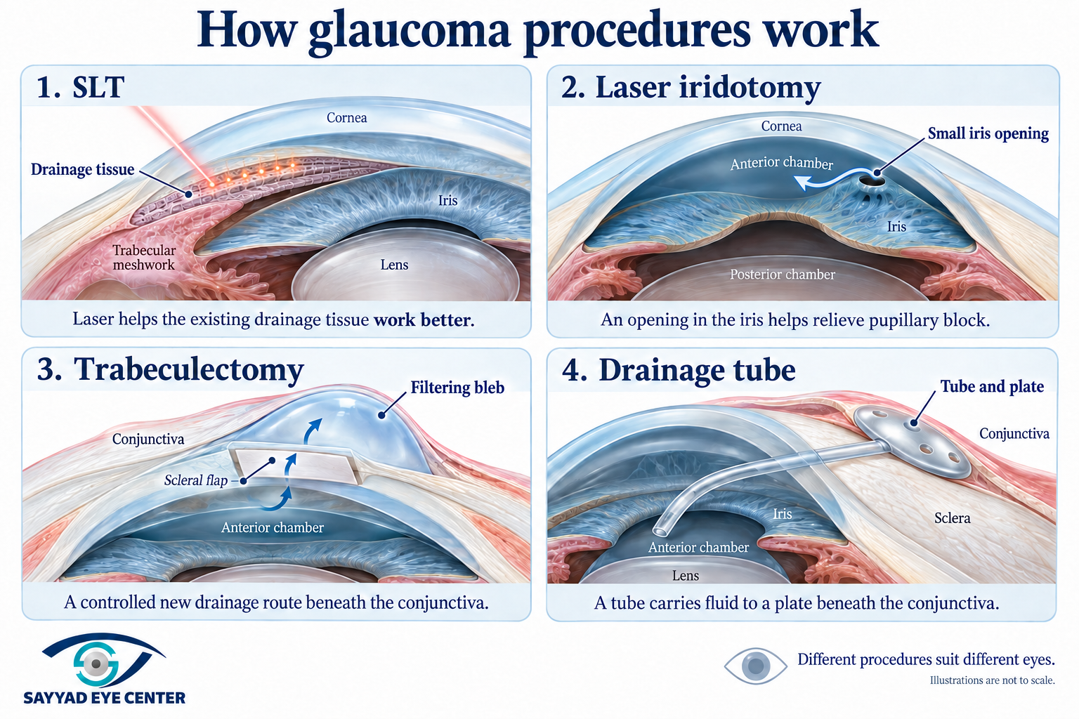 Glaucoma procedures