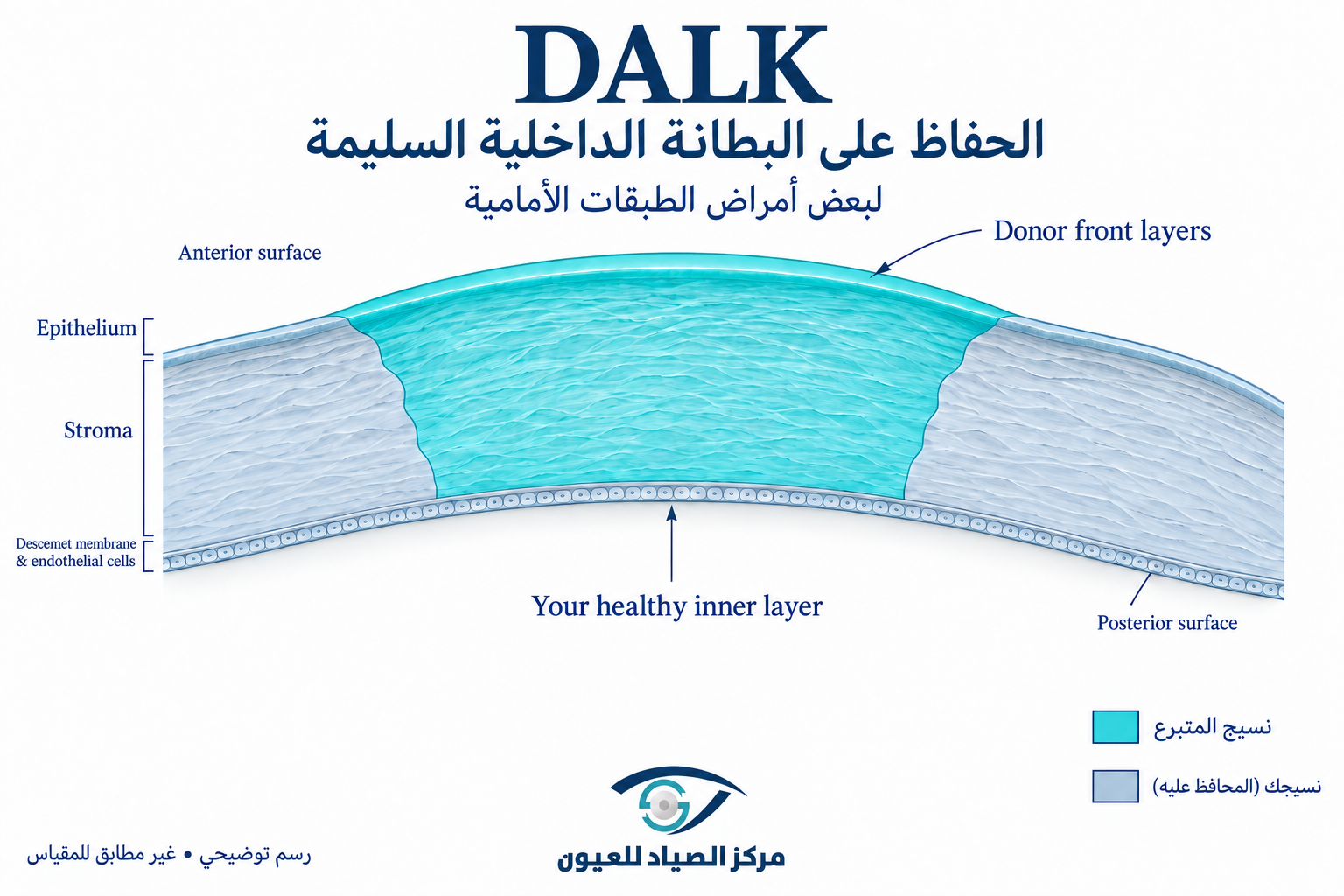 زراعة القرنية الأمامية العميقة DALK
