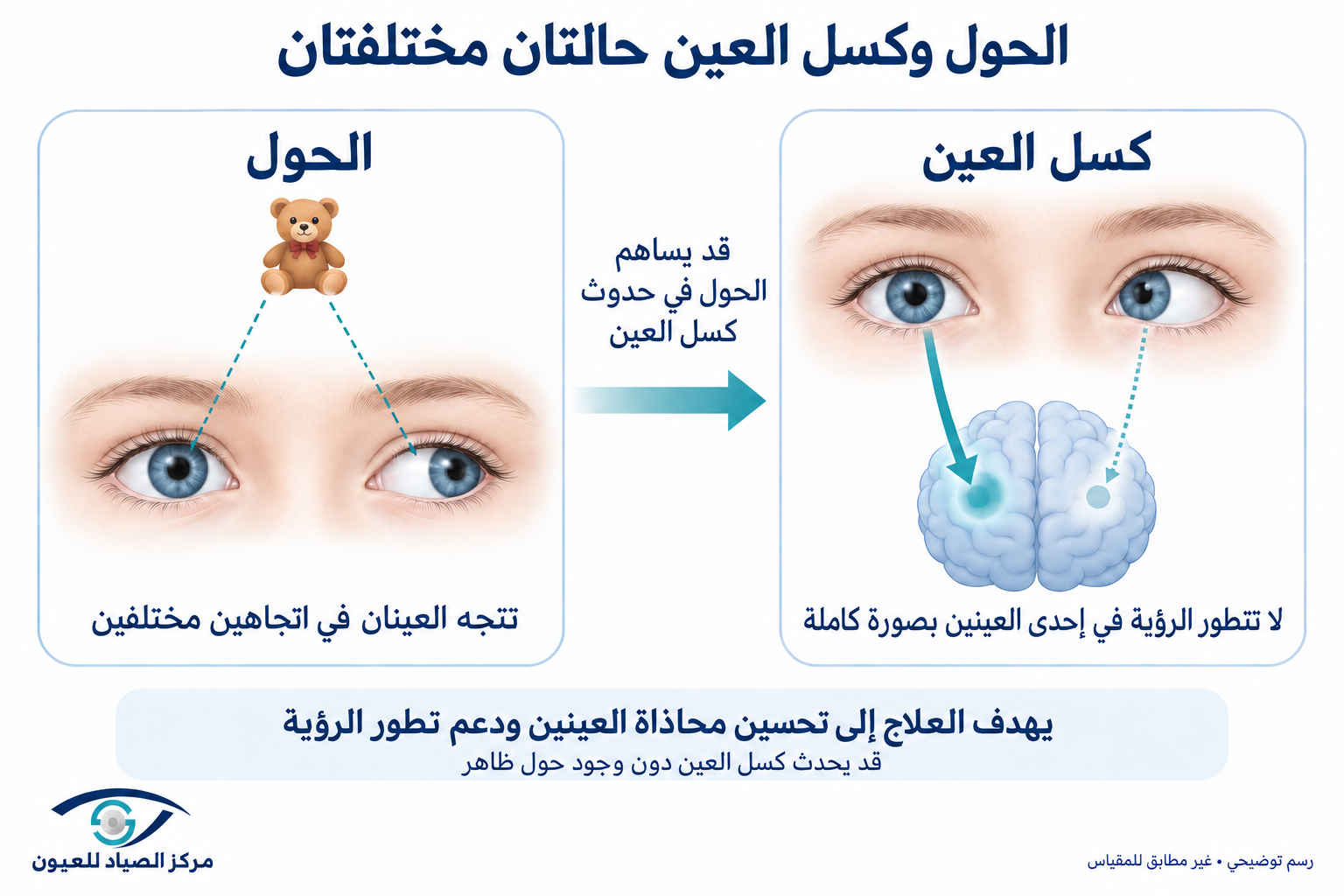 الفرق بين الحول وكسل العين