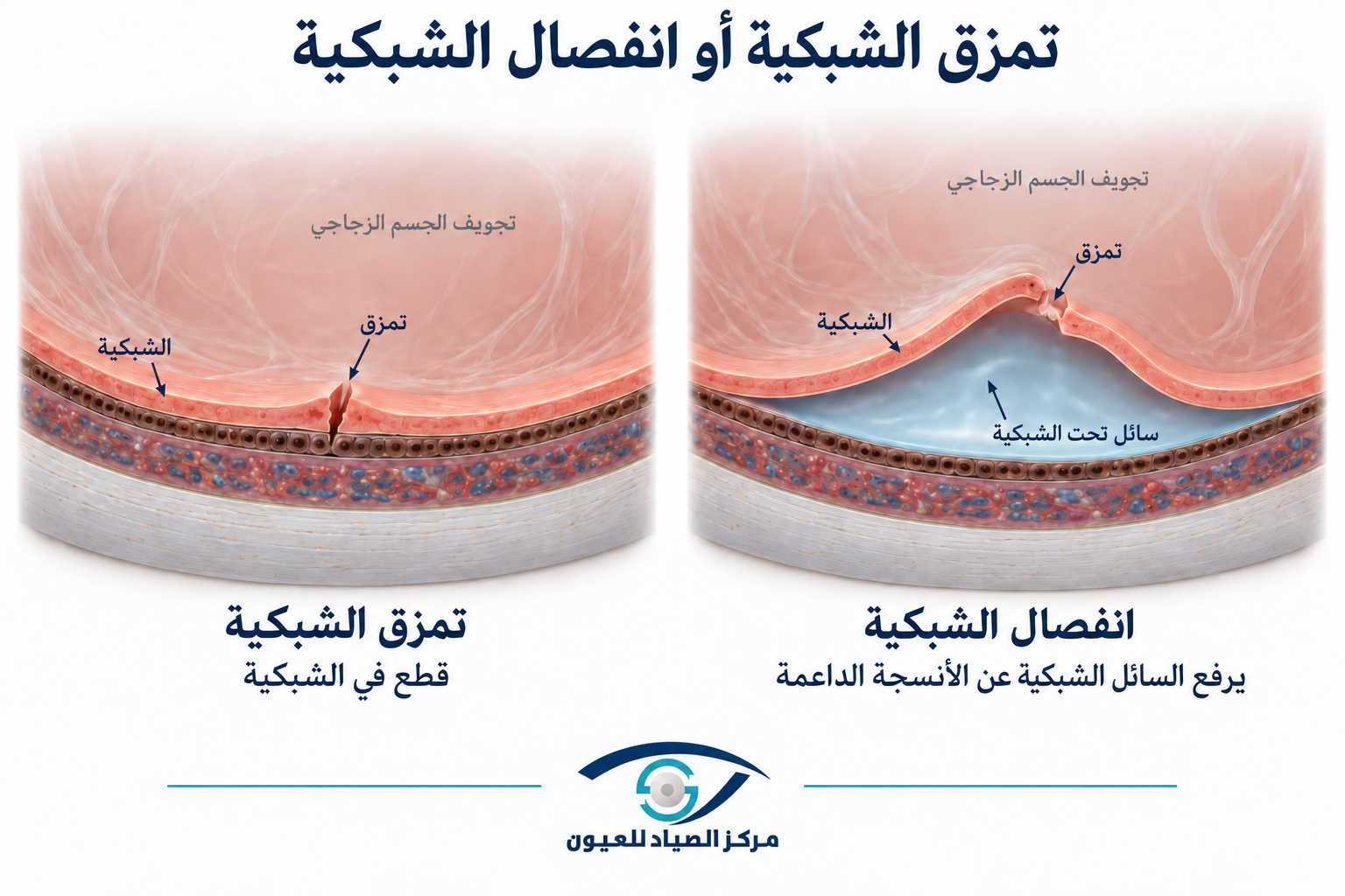 تمزق الشبكية وانفصالها