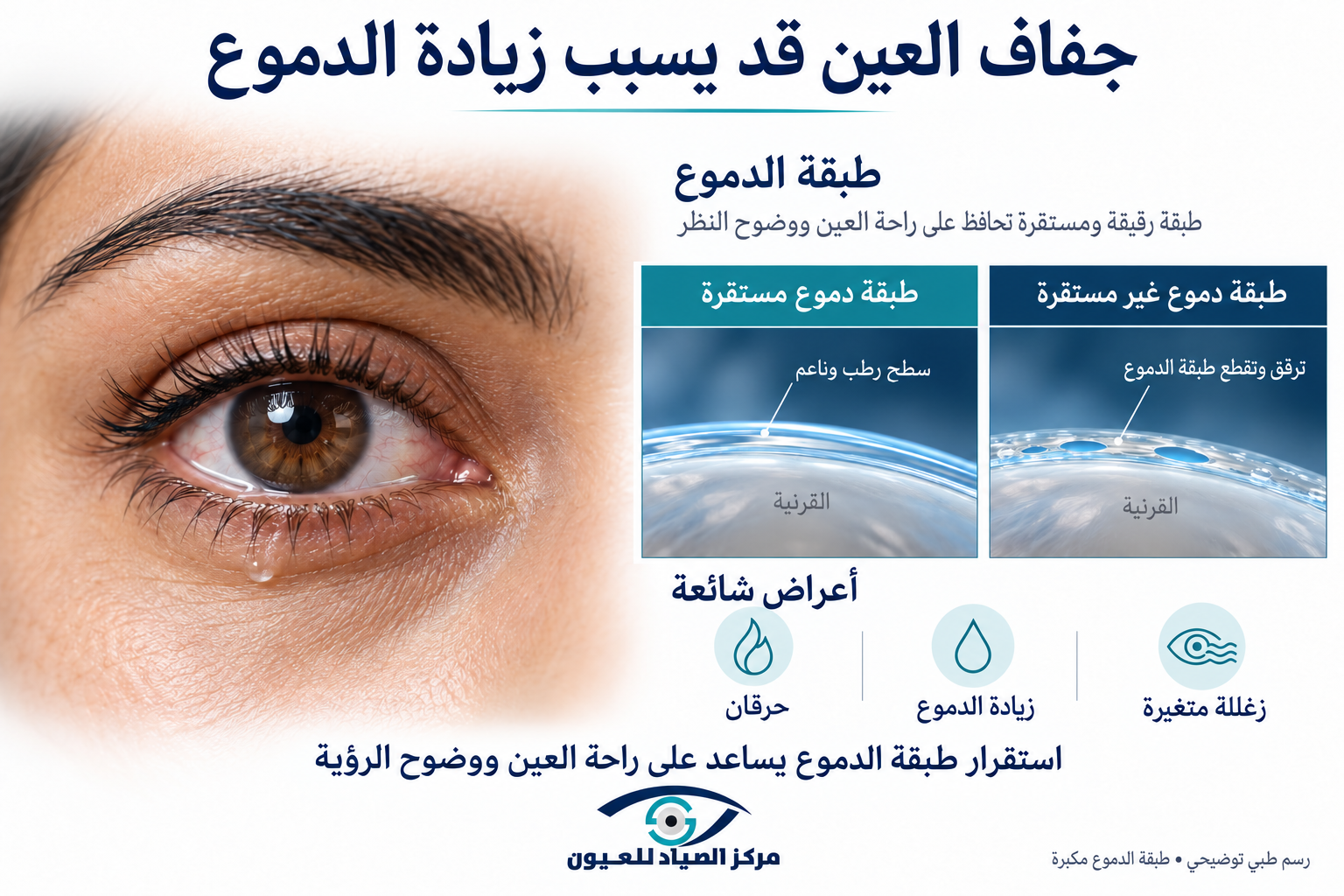 رسم توضيحي لدموع العين والفرق بين طبقة الدموع المستقرة وغير المستقرة.