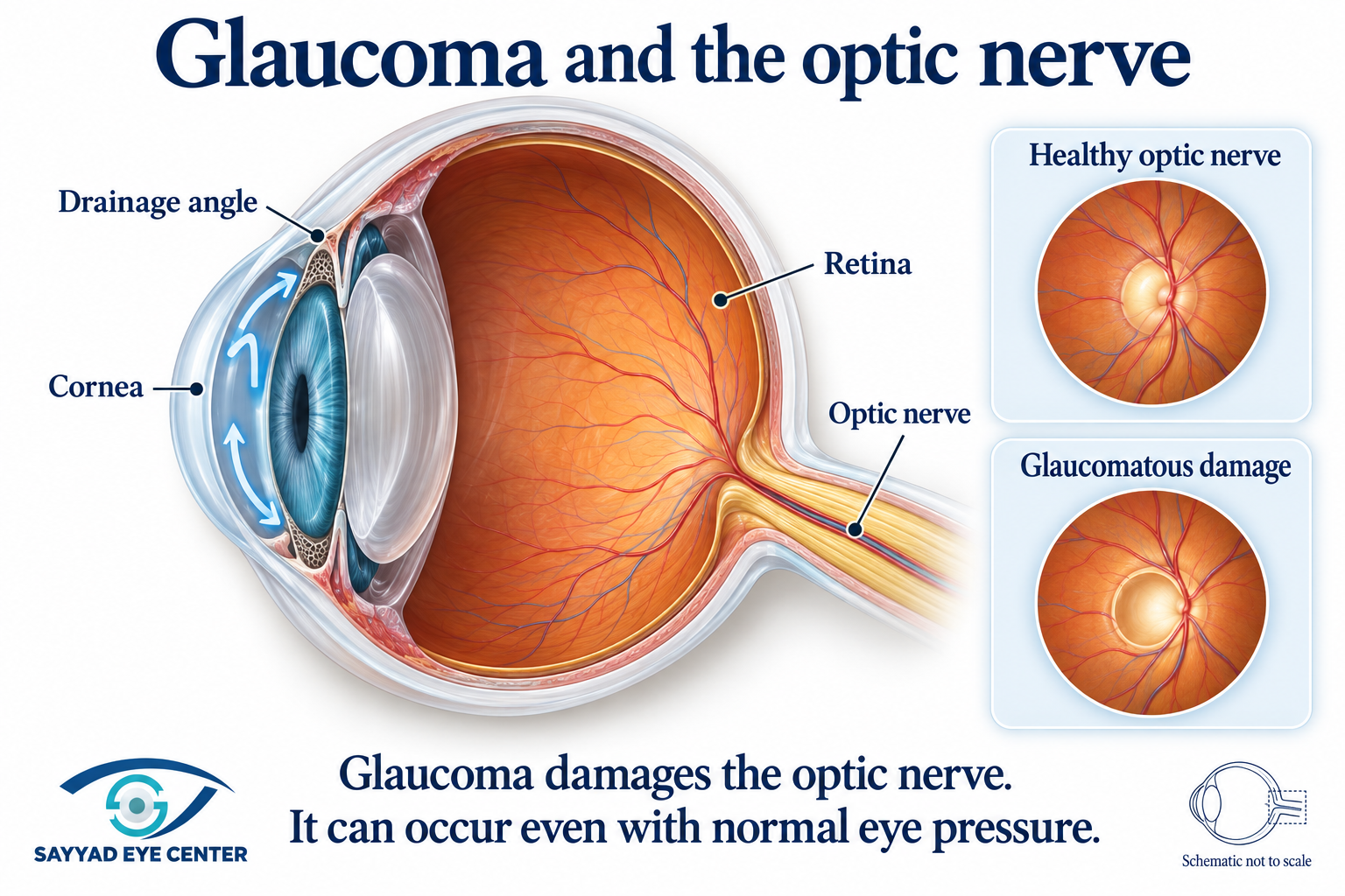 Glaucoma eye