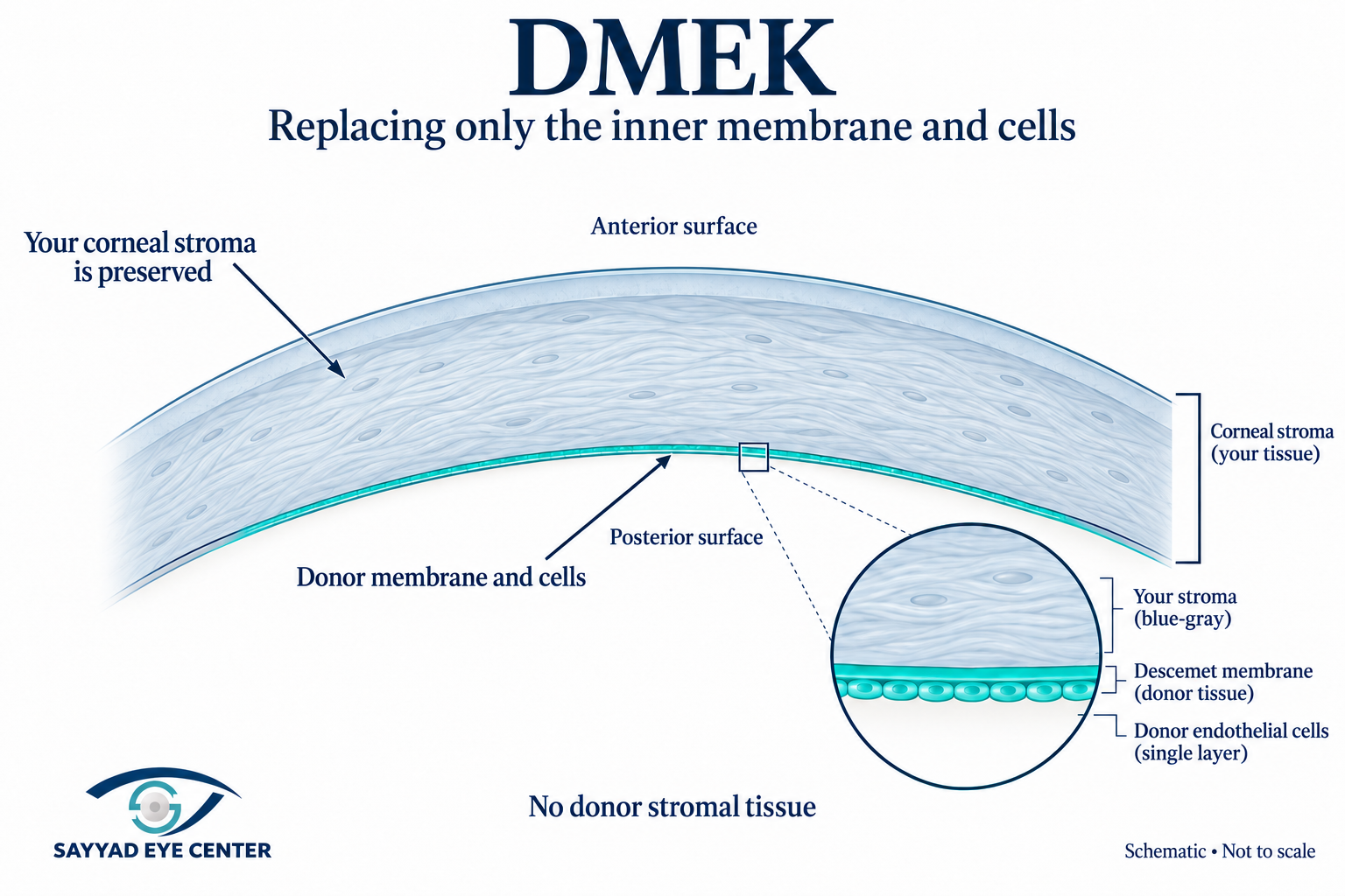 Dmek endothelial corneal transplant