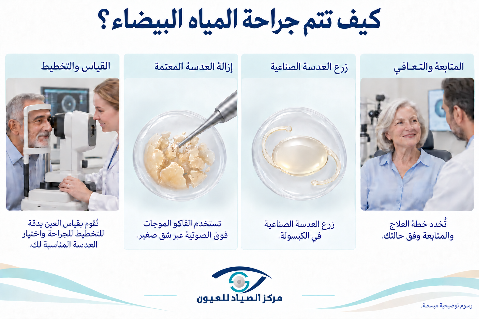 خطوات جراحة المياه البيضاء باستخدام تقنية الفاكو