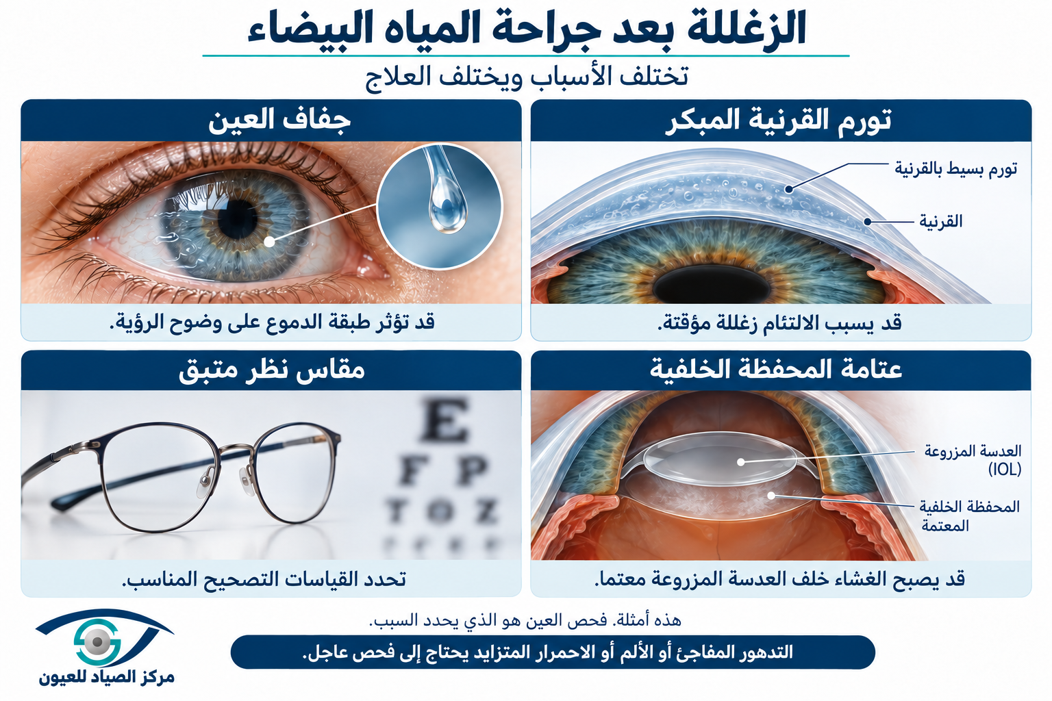 أسباب زغللة العين بعد جراحة المياه البيضاء