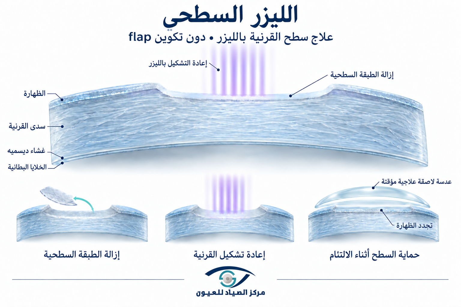 الليزر السطحي PRK