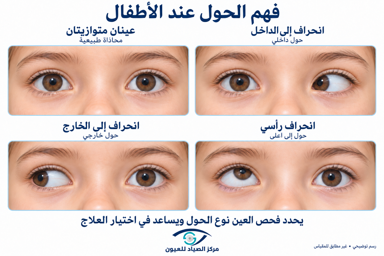 أنواع الحول عند الأطفال