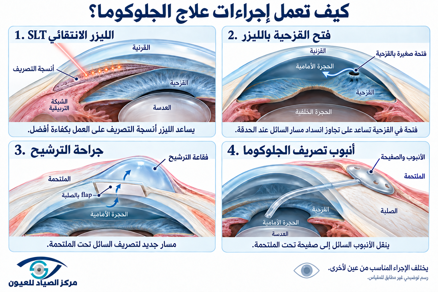 خيارات علاج الجلوكوما