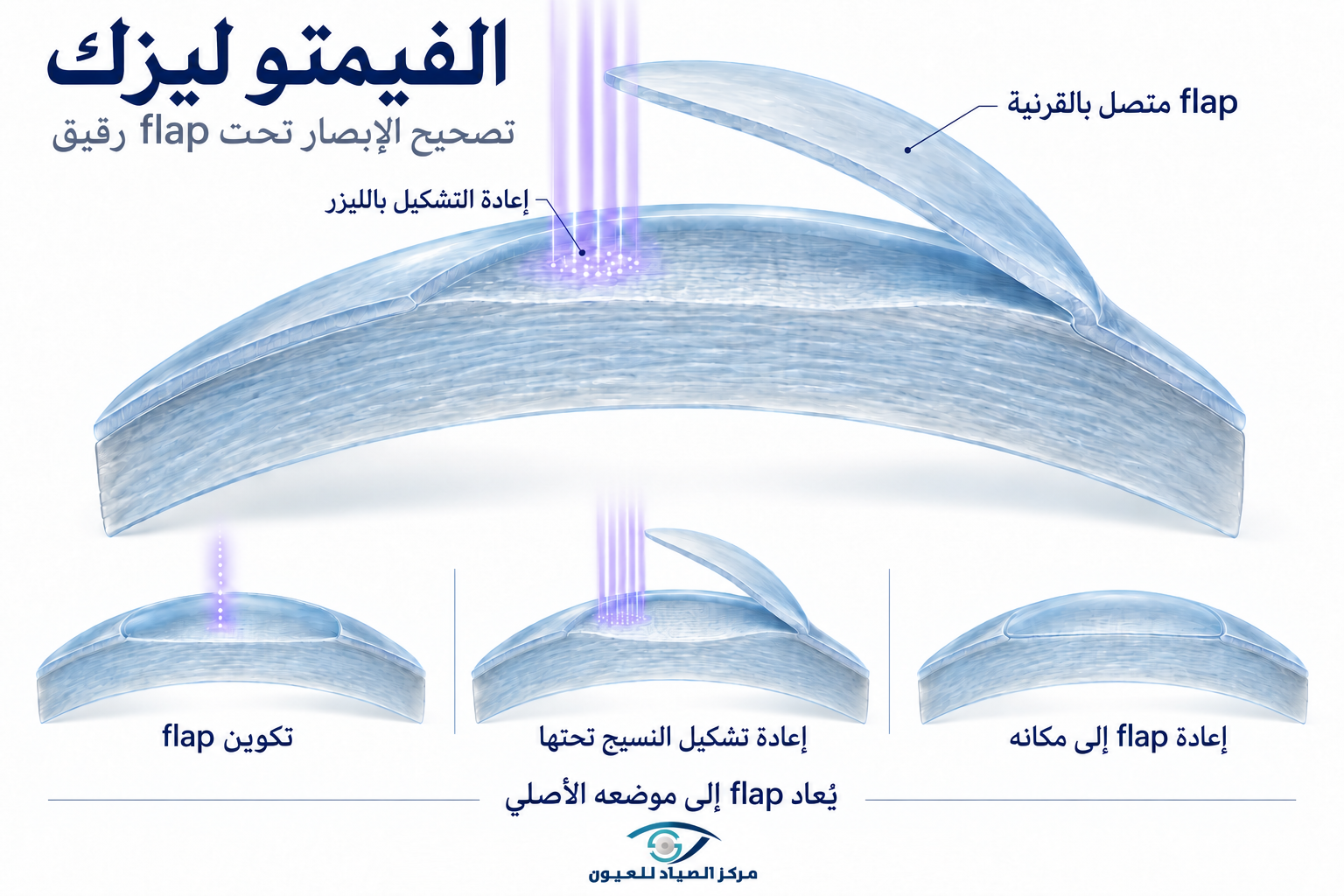 تقنية الفيمتو ليزك