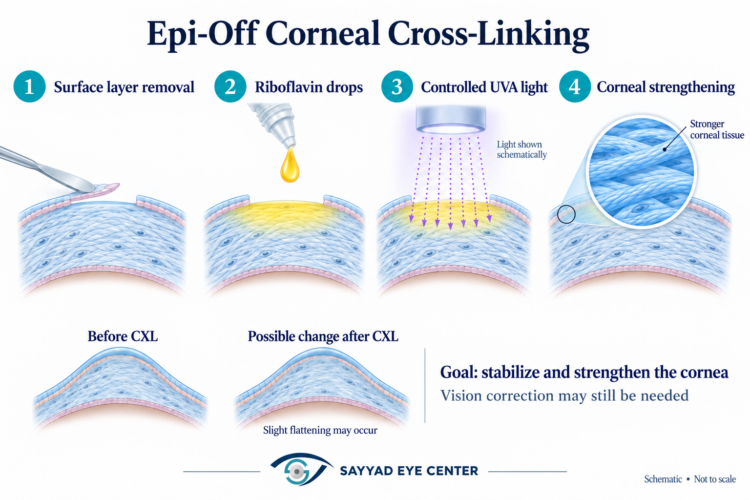 Avedro kxl cross linking patient setup