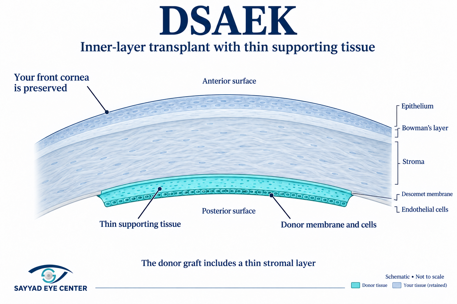 Dsaek endothelial corneal transplant