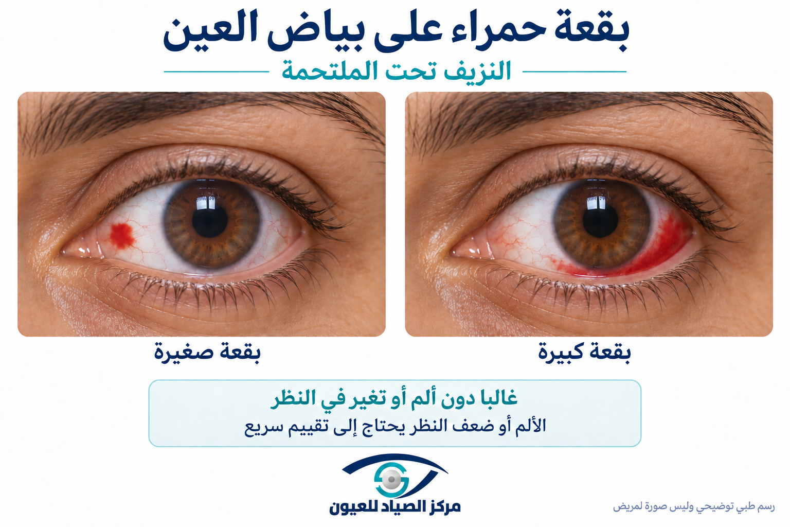 رسم توضيحي لنزيف تحت الملتحمة يظهر كبقعة حمراء على بياض العين.