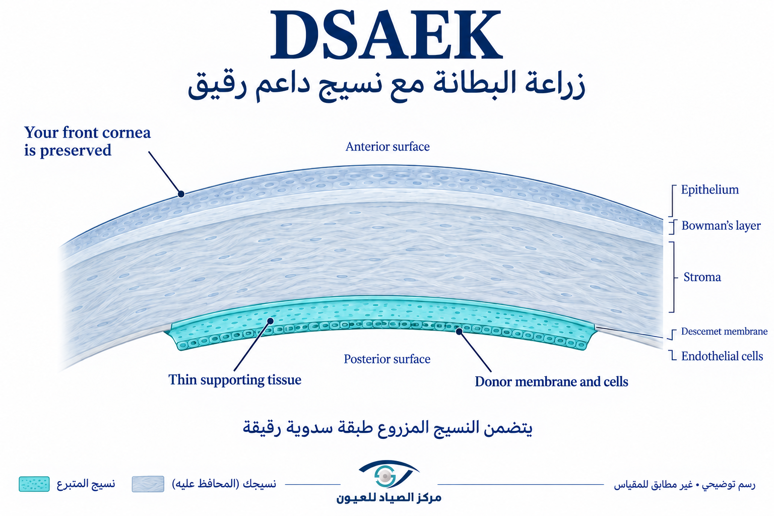 زراعة بطانة القرنية DSAEK