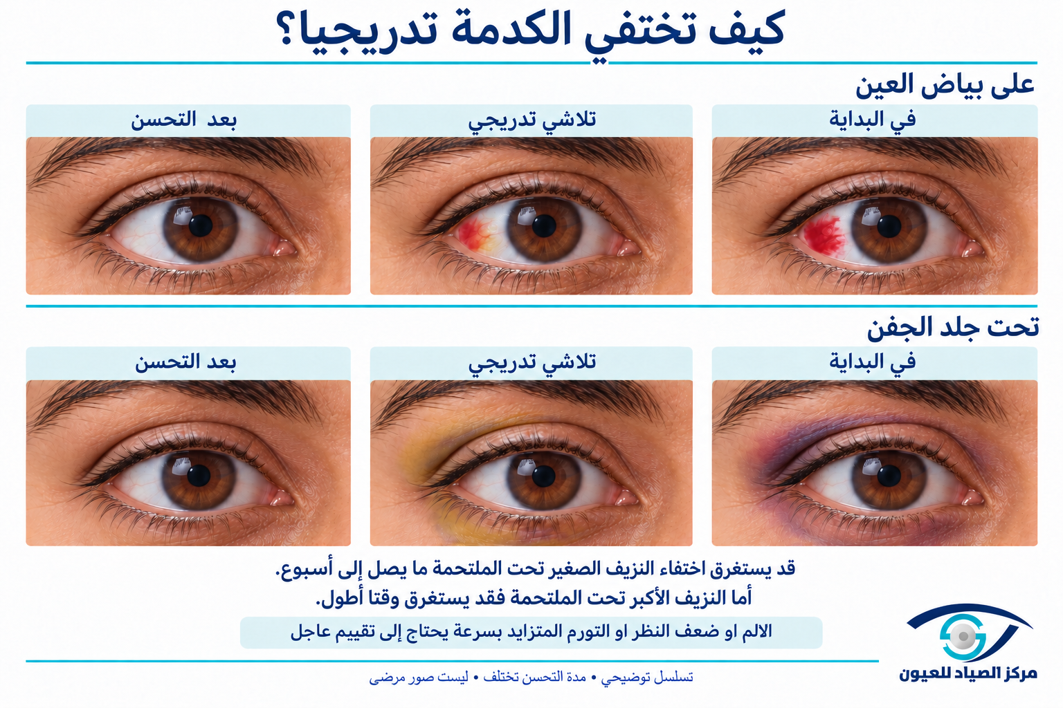 رسم توضيحي للتعافي من نزيف تحت الملتحمة: قد تختفي البقع الصغيرة خلال أسبوع، بينما تحتاج البقع الأكبر إلى وقت أطول.
