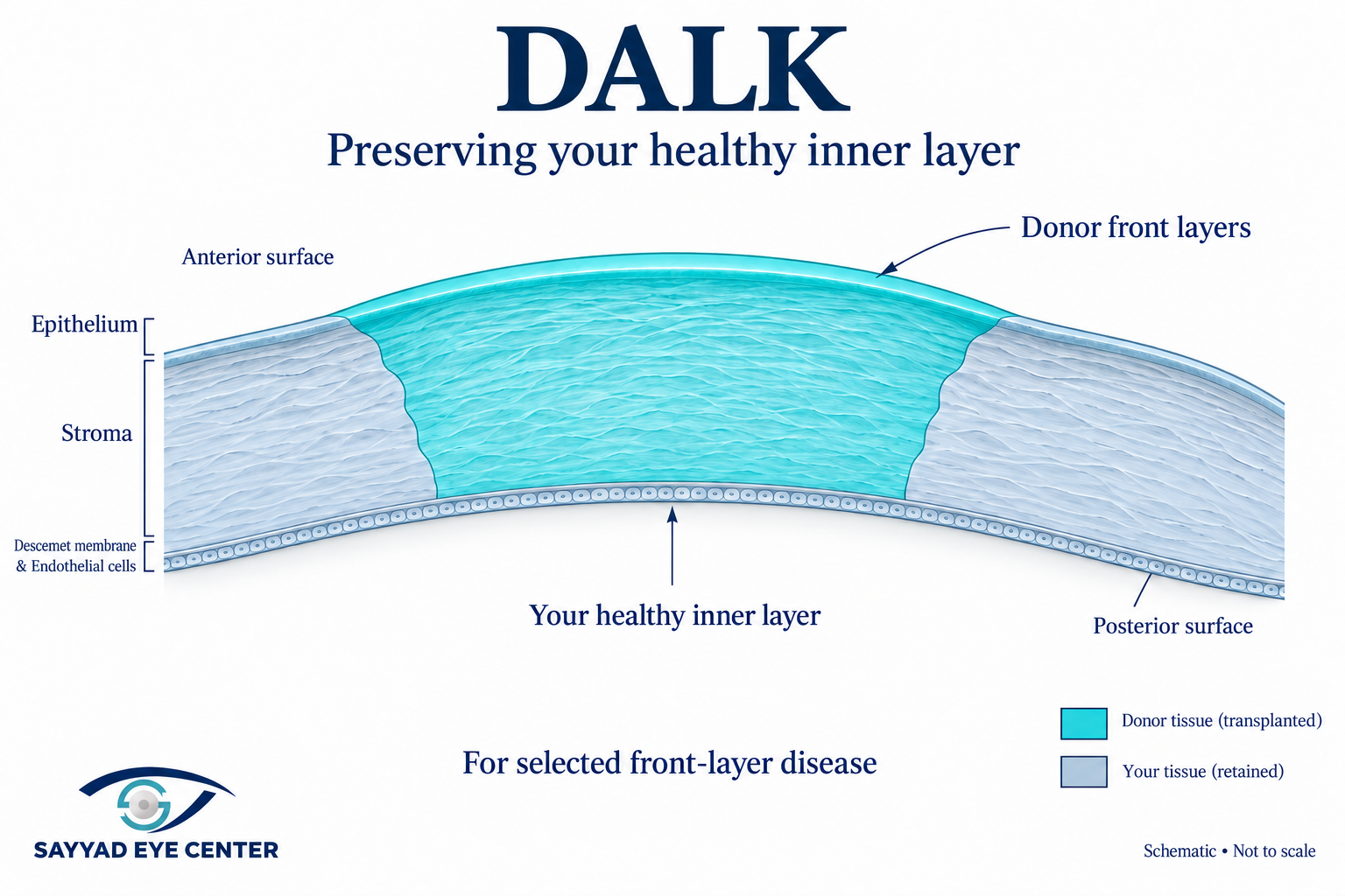 Dalk corneal transplant