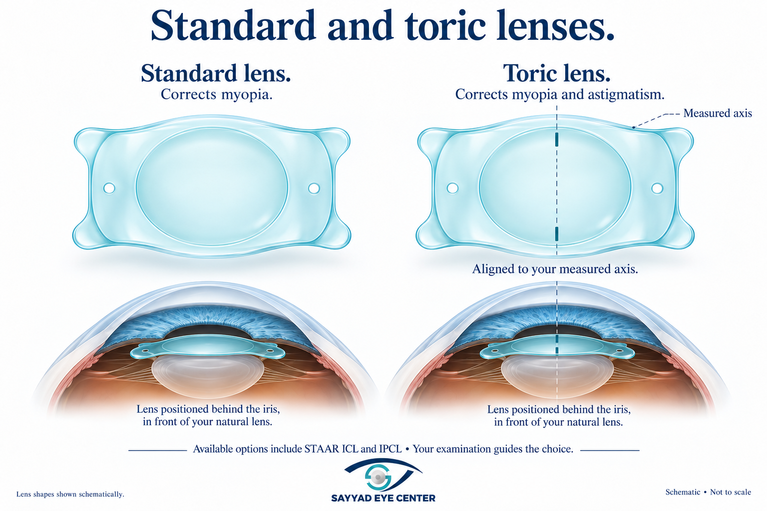 Icl standard versus toric
