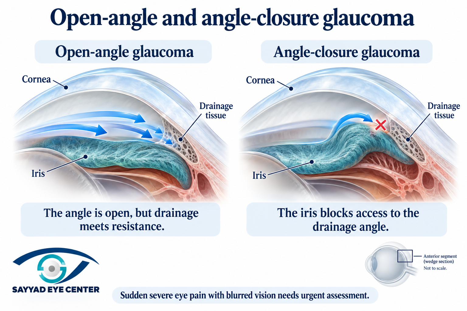 Drainage angles