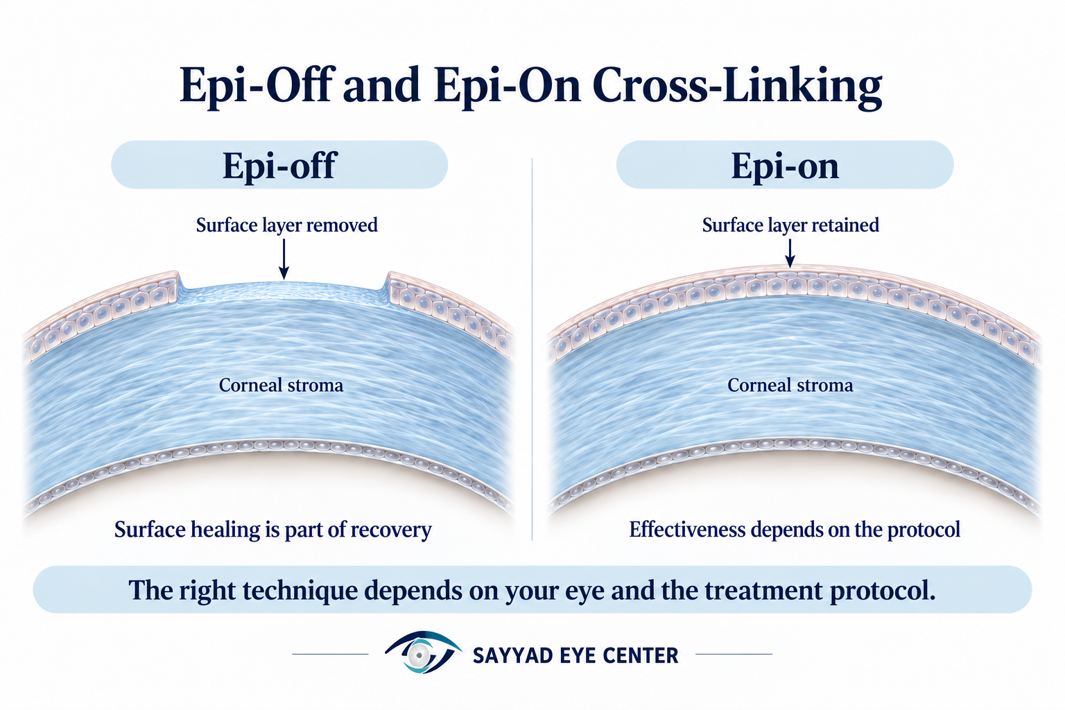 Normal cornea versus keratoconus