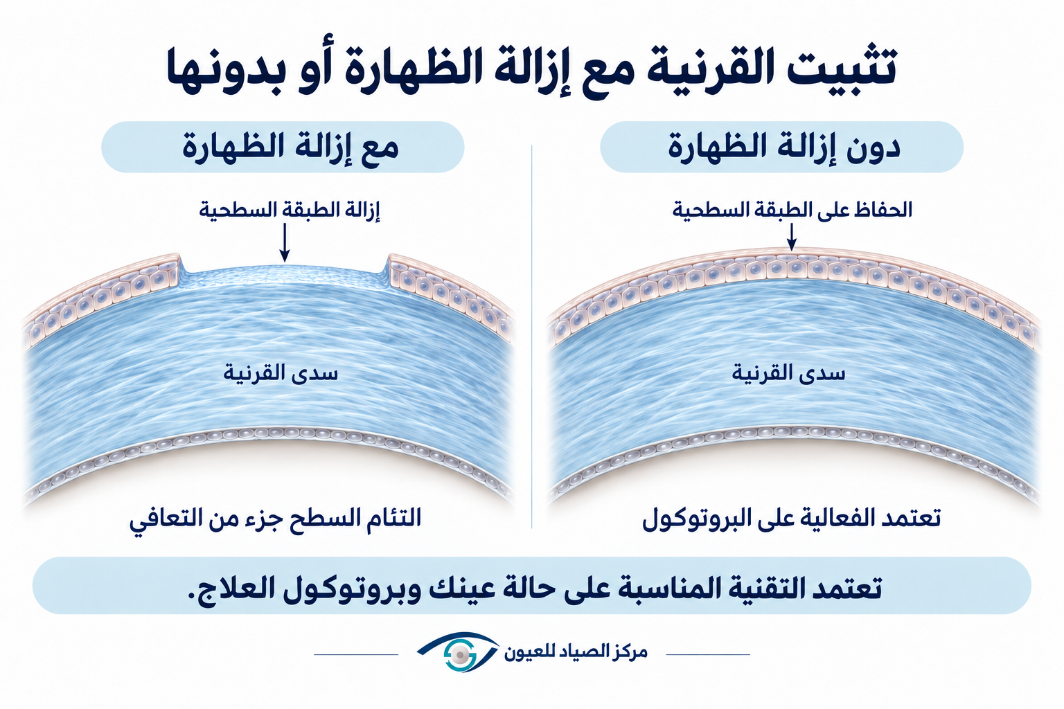 مقارنة تثبيت القرنية مع إزالة الطبقة السطحية ودون إزالتها
