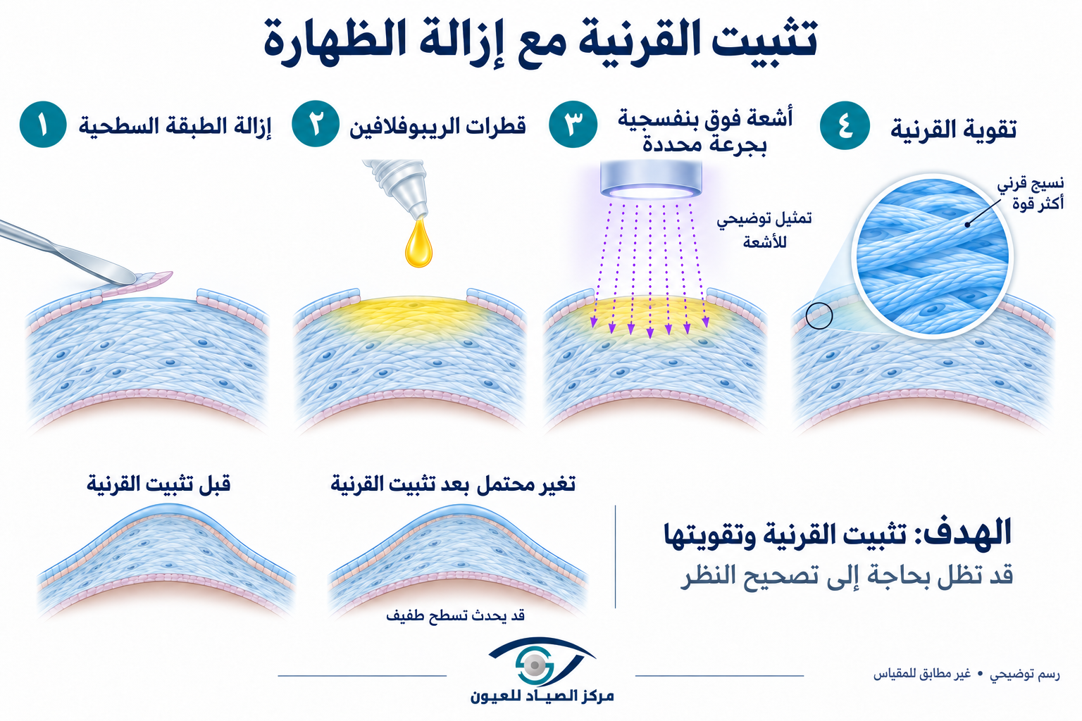 خطوات تثبيت القرنية بإزالة الطبقة السطحية