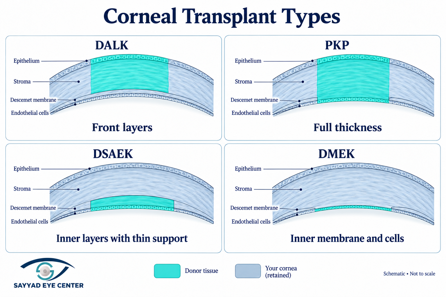 Corneal transplant types dalk pkp dsaek dmek
