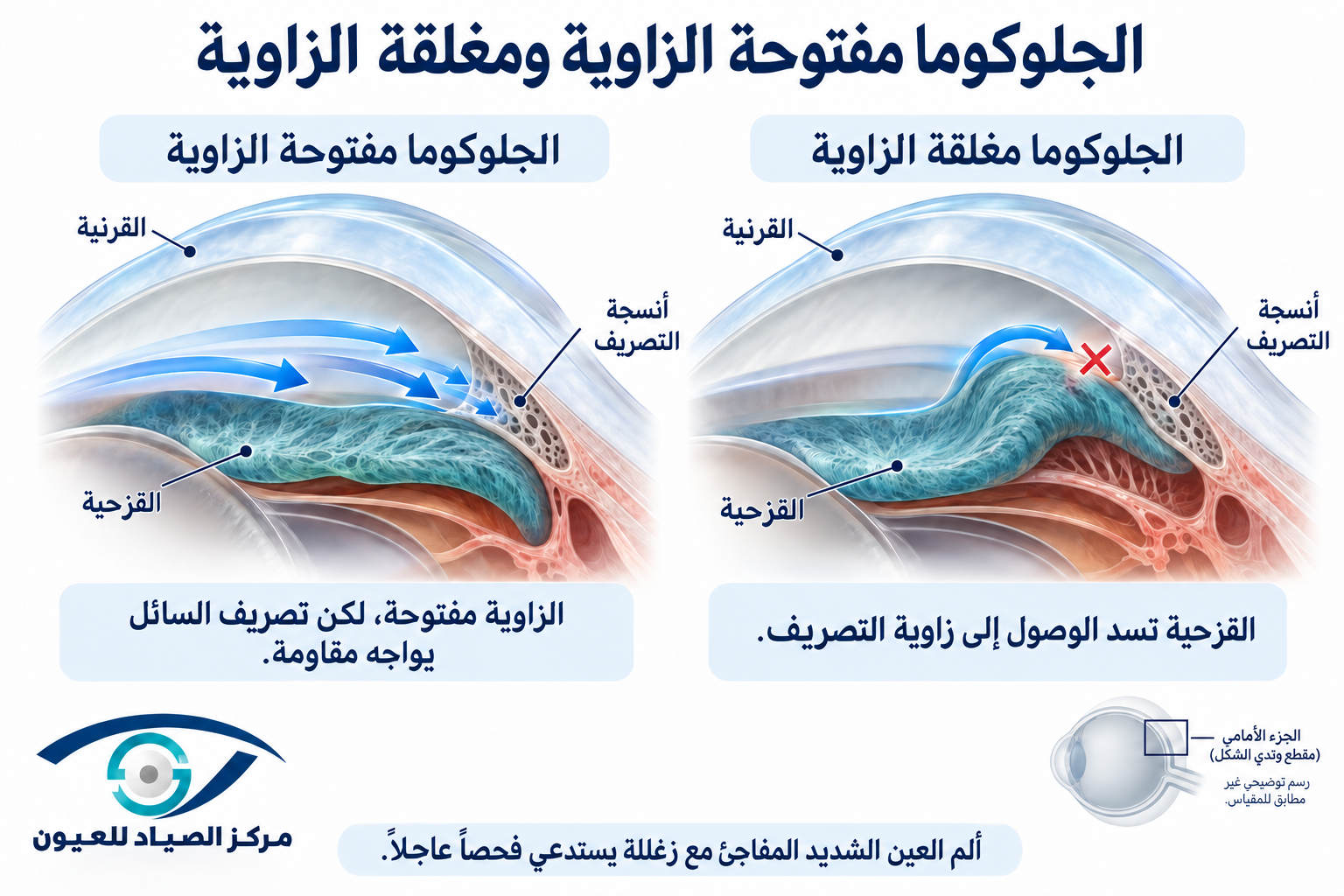 زوايا تصريف السوائل داخل العين